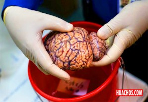 ¿Cuál es el costo cognitivo del COVID? Cerebro de pacientes podrían envejecer 10 años ¿Cuál es el costo cognitivo del COVID? Cerebro de pacientes podrían envejecer 10 años