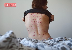 Alerta epidemiológica sobre situación de viruela del mono en varios países del mundo Alerta epidemiológica sobre situación de viruela del mono en varios países del mundo