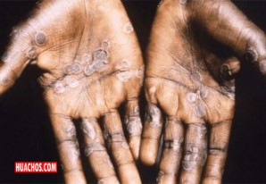 La viruela del mono podría evitarse con un correcto lavado de manos La viruela del mono podría evitarse con un correcto lavado de manos