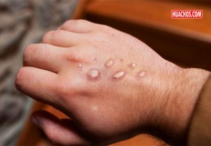 Brote de viruela del mono debe tomarse más en serio, dicen expertos Brote de viruela del mono debe tomarse más en serio, dicen expertos