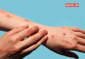 Viruela del mono: número de casos en el Perú se elevó a 126 presentes en 8 regiones Viruela del mono: número de casos en el Perú se elevó a 126 presentes en 8 regiones