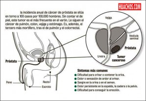 Cómo reconocer el cáncer de próstata Cómo reconocer el cáncer de próstata